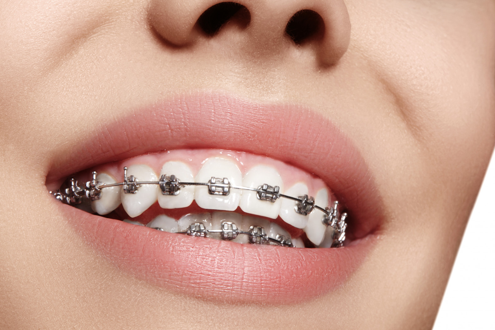Invisible Braces Treatment in Thetford